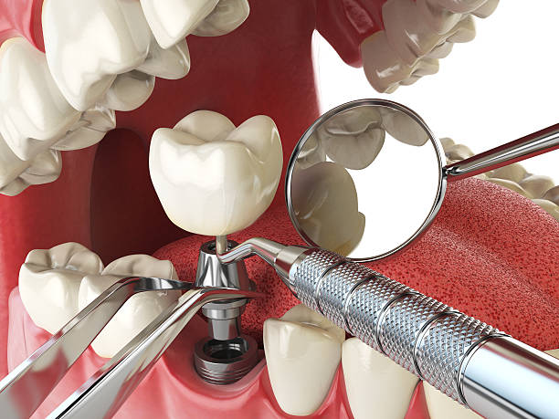 Best Emergency Tooth Extraction in Breckenridge, CO